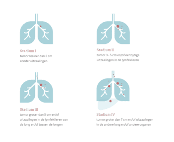 De vier stadia van longkanker
