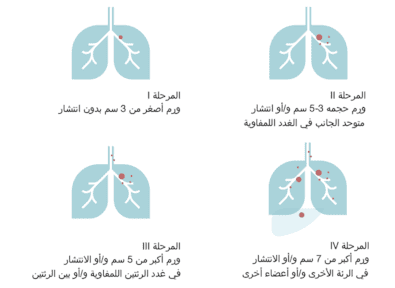 المراحل الأربع لسرطان الرئة