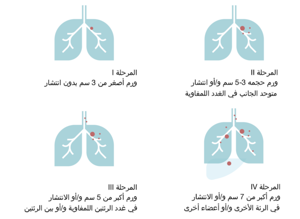 ما هو سرطان الرئة؟