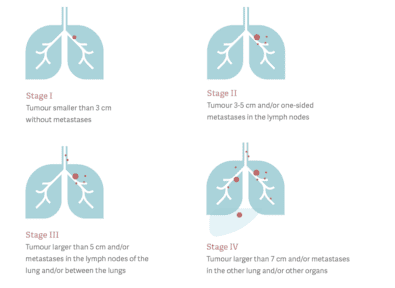The four stages of lung cancer