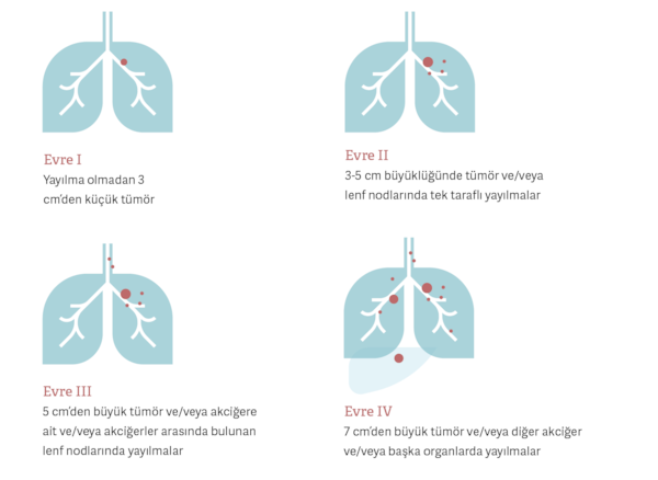 Akciğer kanseri nedir?